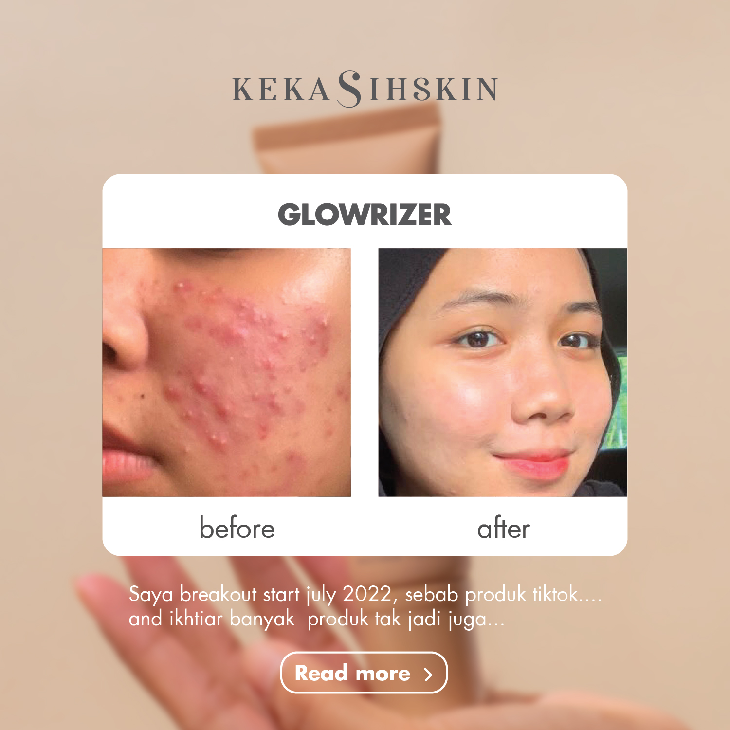 Glowrizer before and after acne prone skin result